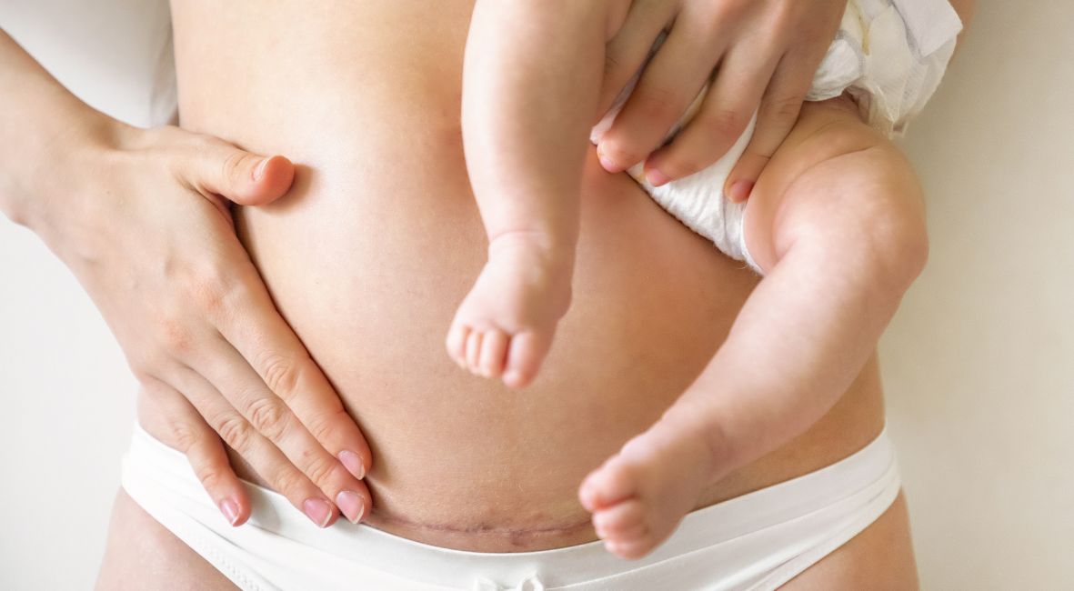 Ste nedavno doživeli carski rez in se sprašujete, kako ohraniti svoje zdravje in dobro počutje po porodu? V tem članku vam bomo predstavili ključne informacije o tem, kako lahko skrbimo za telo mame po posegu.